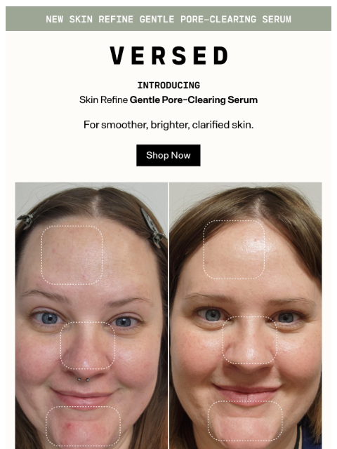 versedskin newsletter: The Results Are In