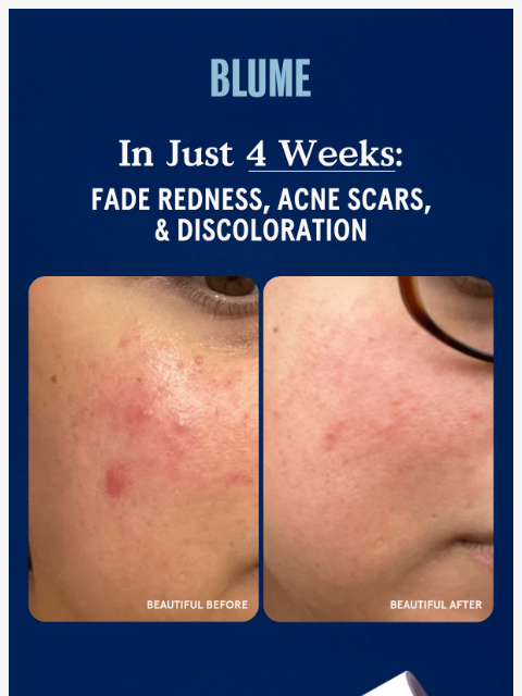 acne-friendly ͏ ͏ ͏ ͏ ͏ ͏ ͏ ͏ ͏ ͏ ͏ ͏ ͏ ͏ ͏ ͏ ͏ ͏ ͏ ͏ ͏ ͏ ͏ ͏ ͏ ͏ ͏ ͏ ͏ ͏ ͏ ͏ ͏ ͏ ͏ ͏ ͏ ͏ ͏ ͏ ͏ ͏ ͏ ͏ ͏ ͏ ͏ ͏ ͏ ͏ ͏ ͏ ͏ ͏ ͏ ͏ ͏ ͏ ͏ ͏ ͏ ͏ ͏ ͏ ͏ ͏ ͏ ͏ ͏ ͏ ͏ ͏ ͏ ͏ ͏ ͏ ͏ ͏ ͏ ͏ ͏ ͏ ͏ ͏ ͏ ͏ ͏ ͏ ͏ ͏ ͏ ͏ ͏ ͏