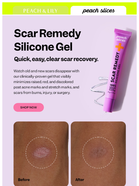 peachandlily newsletter: Fast track your scar recovery