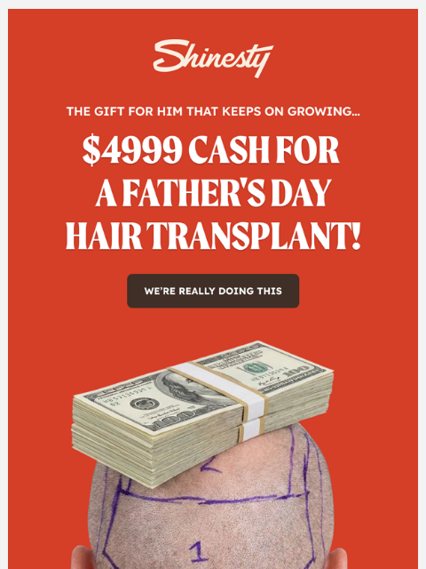 shinesty newsletter: We're giving away money for a Hair Transplant
